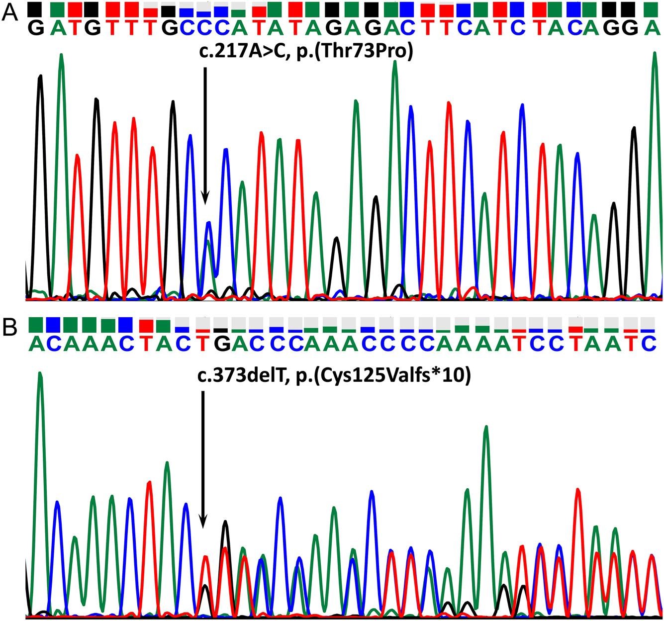 【佳学基因检测】基因解码基因检测鉴别新型 TSHB 变异 (c.217A>C) 导致中枢性甲状腺功能减退和垂体增生 【佳学基因检测】基因解码基因检测鉴别新型 TSHB 变异 (c.217A>C) 导致中枢性甲状腺功能减退和垂体增生